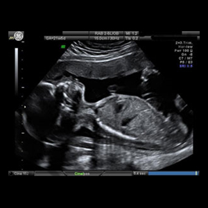 Introduction Training to 3D/4D Ultrasound Optimization(Technique and Ultrasound Anatomy)