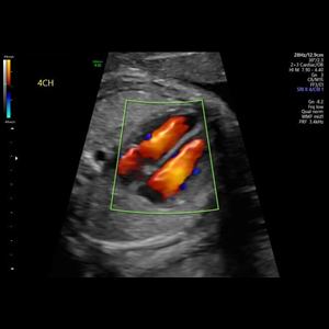 Introduction Training to Fetal Echo Ultrasound -Basic Level-